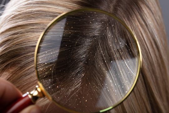 Dandruff In Hair Seen Through Magnifying Glass