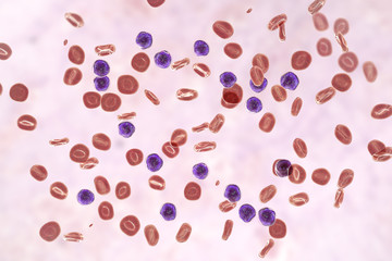 Acute lymphoblastic leukemia