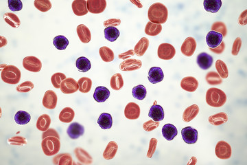 Acute lymphoblastic leukemia