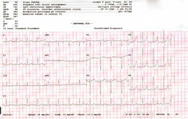 cardiogram waveform from an EKG showing Abnormak EKG test a patient.