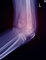 X-ray Knee join Showing large osteolytic lesuion of medial aspect of left distal femur.with soft...