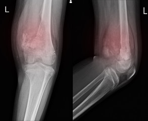 X-ray Knee join Showing large osteolytic lesuion of medial aspect of left distal femur.with soft...