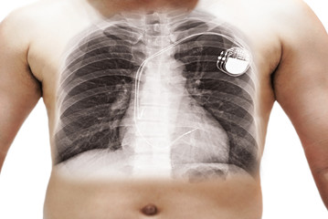 Close up Human chest with pacemaker in chest,soft and blurry when views full resolution. Isolated background . - obrazy, fototapety, plakaty