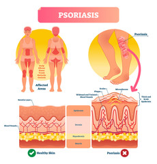 Psoriasis vector illustration. Skin disease and illness. Labeled structure.