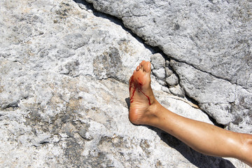A bleeding foot caused by accident 