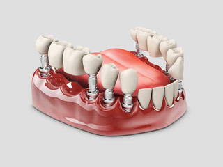 3d Illustration of a Fixed partial denture bridge, isolated white