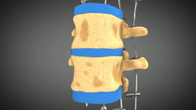 Part of the human spine with fixators animated