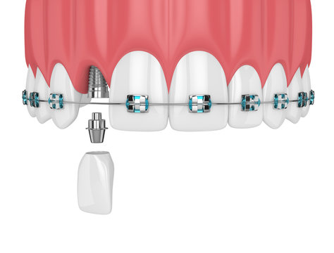 3d render of teeth with orthodontic braces and dental implant