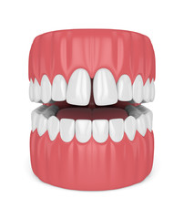 3d render of teeth with diastema