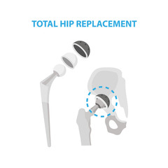 Osteoarthritis of the Hip Joint and Hip Replacement Surgery medical infographic elements isolated on white background. Artificial hip joint construction made from metal infographic elements.