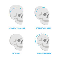 Set of Skulls normal and deformed, hydrocephalus, scaphocephaly, microcephaly vector flat icons, skull medical illustrations, anatomical infographic elements isolated on white background.