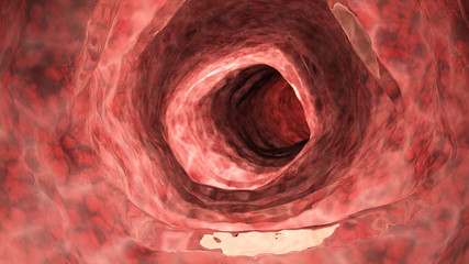 3d rendered medically accurate illustration of an inflamed colon - obrazy, fototapety, plakaty