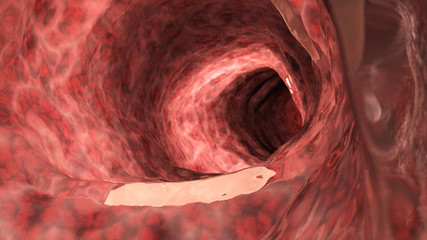 3d rendered medically accurate illustration of an inflamed colon