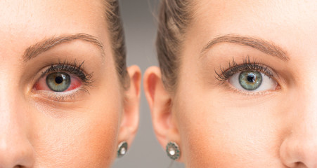 Red eye before and after eyewash