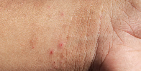 Rash on sensitive skin, skin problem with allergy rash, soft focus