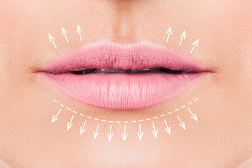 Woman lips before filler injections. Fillers. Lip augmentation - obrazy, fototapety, plakaty