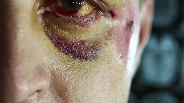 Hematoma of left eye and trauma of face, man with injury of face looks at the camera in medical center, roentgenogram of head at background. It is not a make-up, real trauma after falling off a bicycl