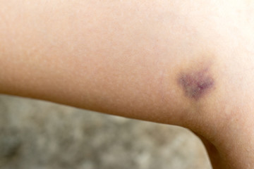 Closed up of bruise injury on female leg background