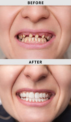 smile after and before dental crown installation process