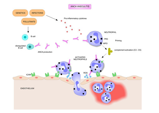 ANCA (anti-neutrophil cytoplasmatic antibody) related vasculitis.