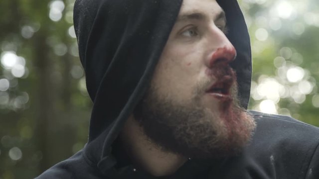 Man with broken nose with bleeding looks around in park. 4K
