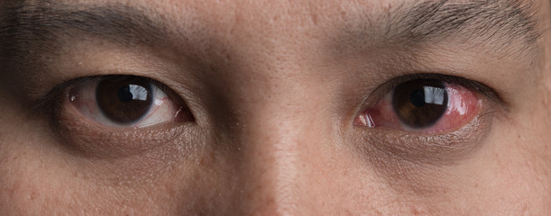 Human's red eye conjunctivitis - obrazy, fototapety, plakaty