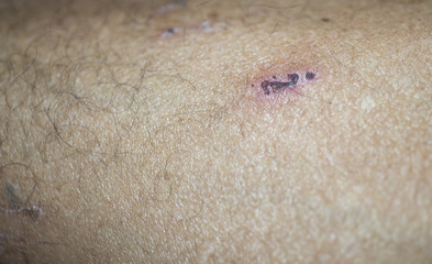 Scars are scabs, skin lesions.