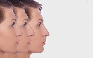 profile female before and after plastic surgery on her nose. Comparison ofwoman nose after plastic...
