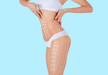 The cellulite removal plan. White markings on young woman body preparing for plastic surgery. Concept of slimming, liposuction, strand lifting