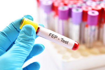 Fototapeta premium Blood sample tube for FEP or free erythrocyte protoporphyrin test, diagnosis for anemia disease 