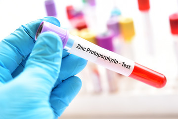Obraz premium Blood sample tube for zinc protoporphyrin or ZPP test, diagnosis for anemia disease 