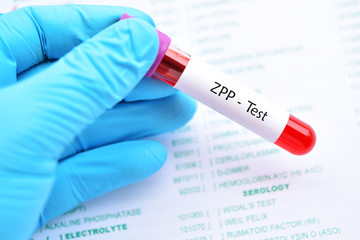 Blood sample tube for ZPP or zinc protoporphyrin test, diagnosis for anemia disease
