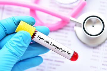 Blood sample tube for erythrocyte protoporphyrin test, diagnosis for anemia disease
