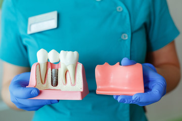 hands of the dentist hold a breadboard model of the tooth with an implant