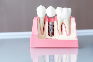 Close up of a Dental implant model. Selective focus.