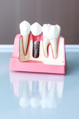 Close up of a Dental implant model. Selective focus.