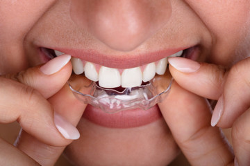 Woman Putting Transparent Aligner In Teeth