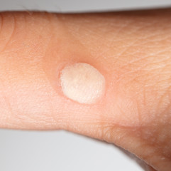 Fototapeta premium Hydrogen peroxide on corn on the skin