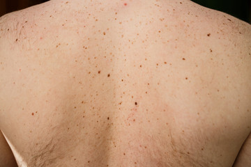 Close up detail of the bare skin on a man back with scattered moles and freckles , Disorders of body , Checking benign moles , Sun effect on skin. Birthmarks on skin