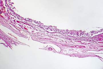 Chronic bronchitis, photo under microscope, light micrograph