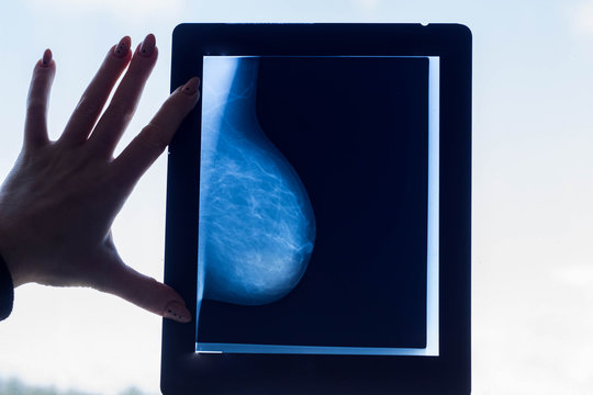 Doctor looks at a breast mammography image