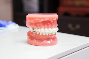 Dentist demonstration teeth model of varities of orthodontic bracket or brace with flesh pink gums