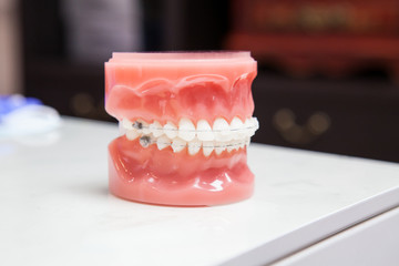 Dentist demonstration teeth model of varities of orthodontic bracket or brace with flesh pink gums