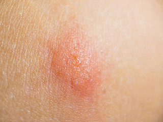 Insect bite on female skin