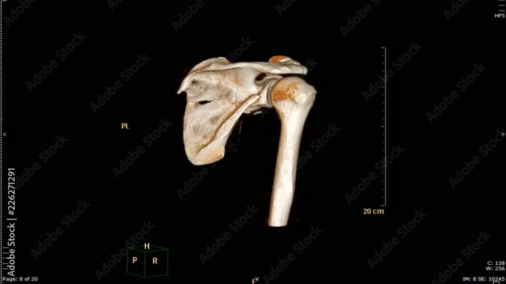 Poster ct scan 3d rendering image show fracture of clavicle and scapular rotating view.