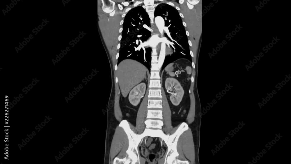 Poster ct scan ( computed tomography ) of whole abdomen with contrast media injection , coronal and sagitta