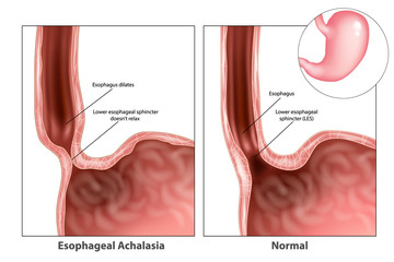 Esophageal achalasia, often called simple achalasia. Lower esophageal sphincter doesn’t relax. Esophageal achalasia, often called simple achalasia