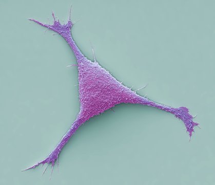 Breast cancer cell, SEM