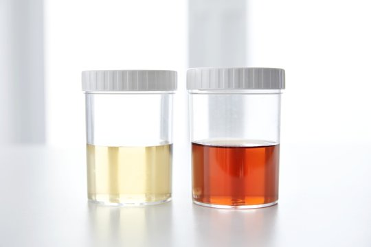 Blood In Human Urine In Sample Pot