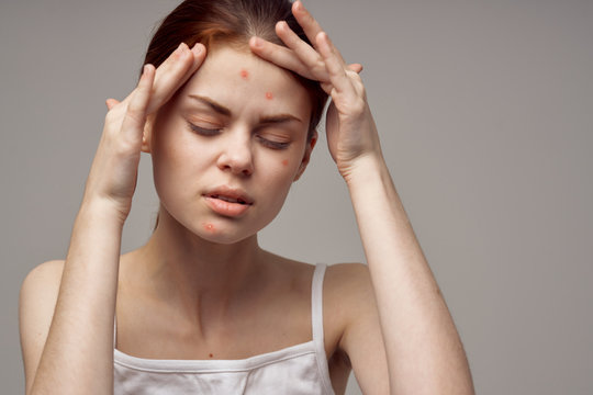 Woman With Red Pimple On Face